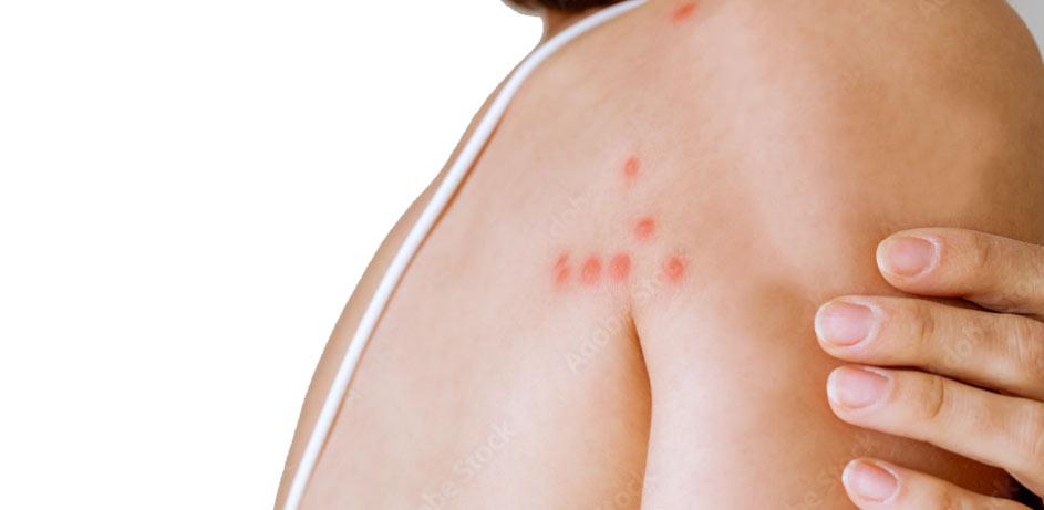 Lutter contre les punaises de lit